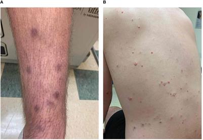 Case report: Persistent shedding of a live vaccine-derived rubella virus in a young man with severe combined immunodeficiency and cutaneous granuloma